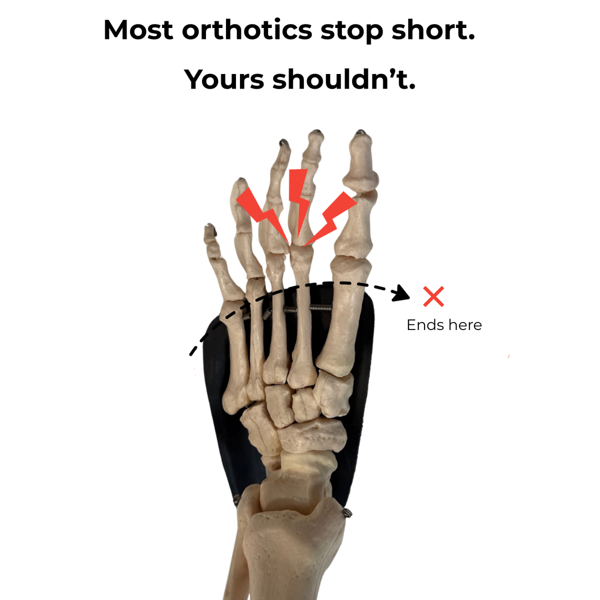 Custom Foot Orthotics with Impression Kit